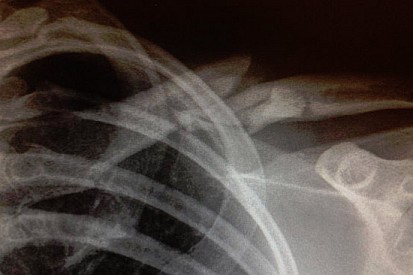 La clavicola di Geoff May è fratturata in quattro punti!
