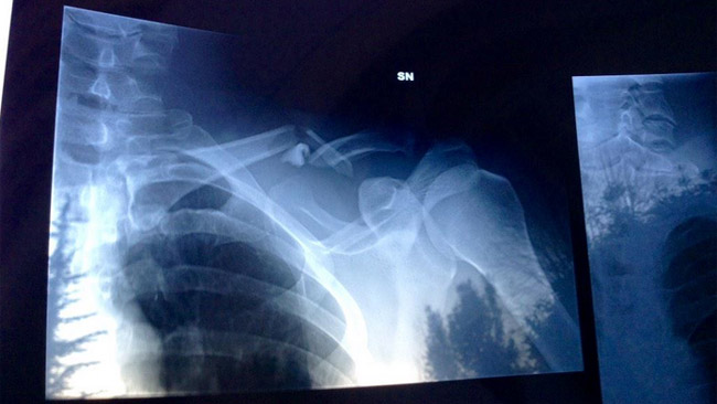 Zanardi si frattura una clavicola con la handbike