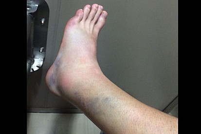 Ecco com'è ridotta la gamba di Casey Stoner