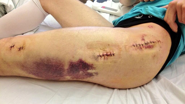 Jonathan Rea mostra su Twitter le sue cicatrici